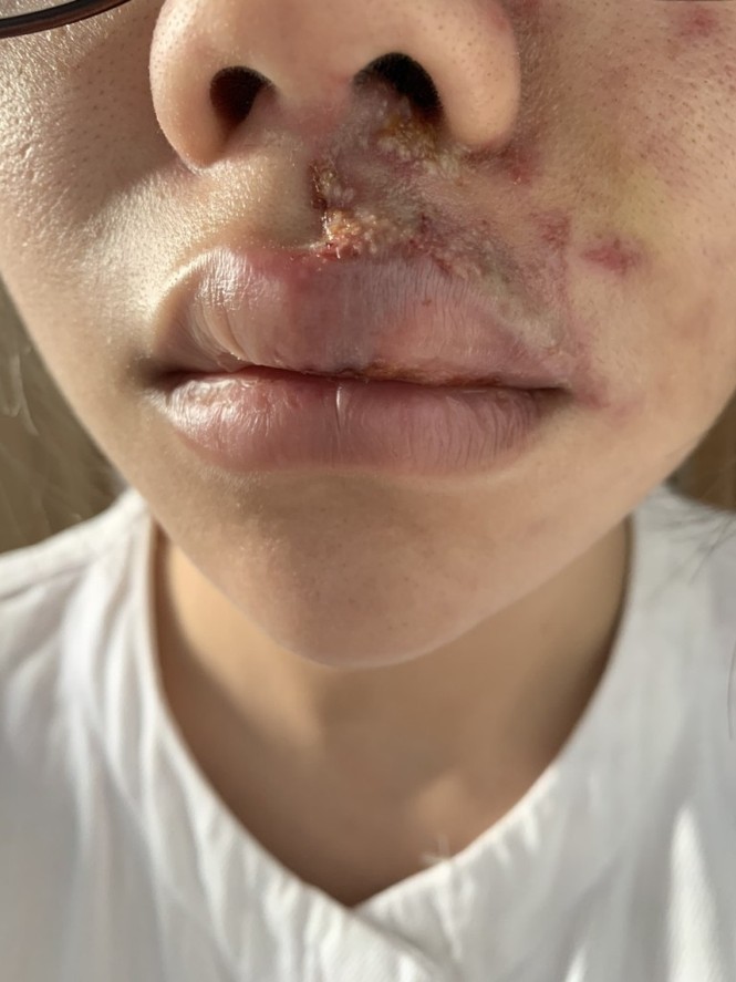 TPHCM: Cô gái trẻ sưng phù mặt khi tiêm filler làm đẹp - ảnh 1