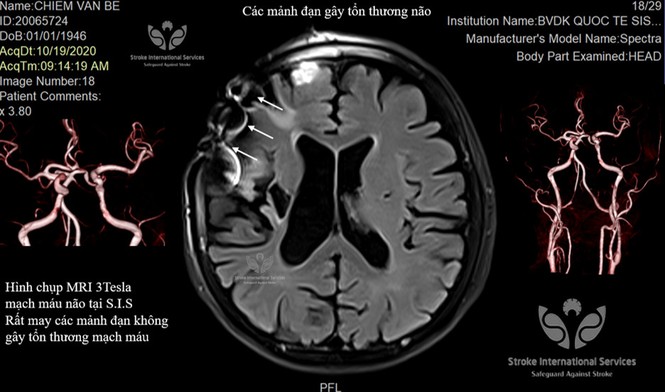Gắp hàng trăm mảnh đạn trong đầu một thương binh - ảnh 1