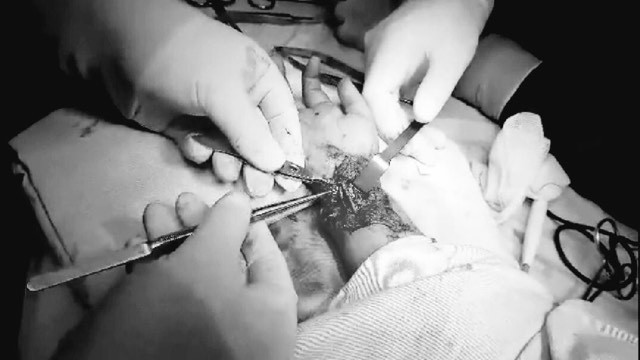 Đang tắm gặp tai nạn bất ngờ, bé trai 6 tuổi gần đứt lìa bàn tay - ảnh 1