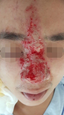 Mù mắt vì tiêm filler nâng mũi - ảnh 1