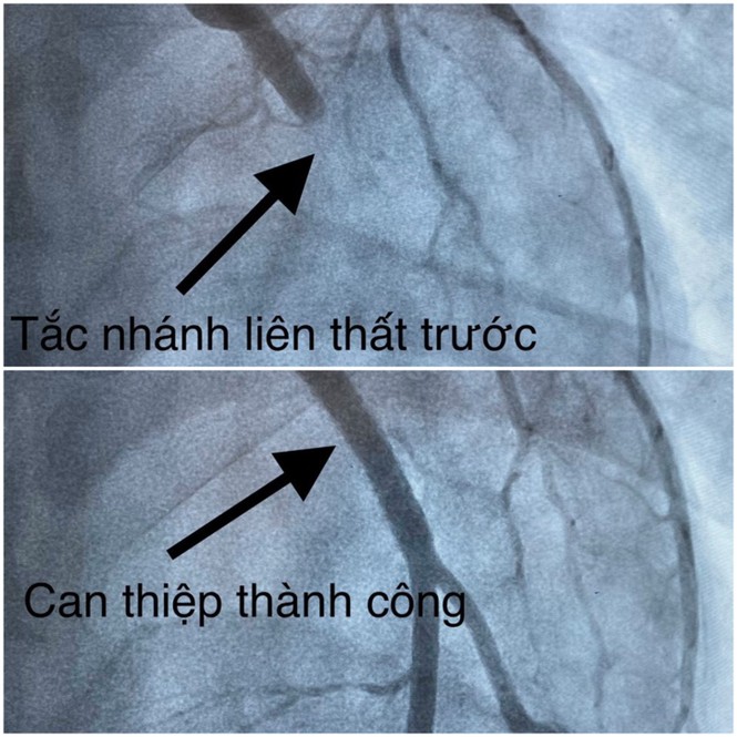 23 tuổi, nam thanh niên đột quỵ vì hút thuốc và nhậu trong nhiều năm - ảnh 2