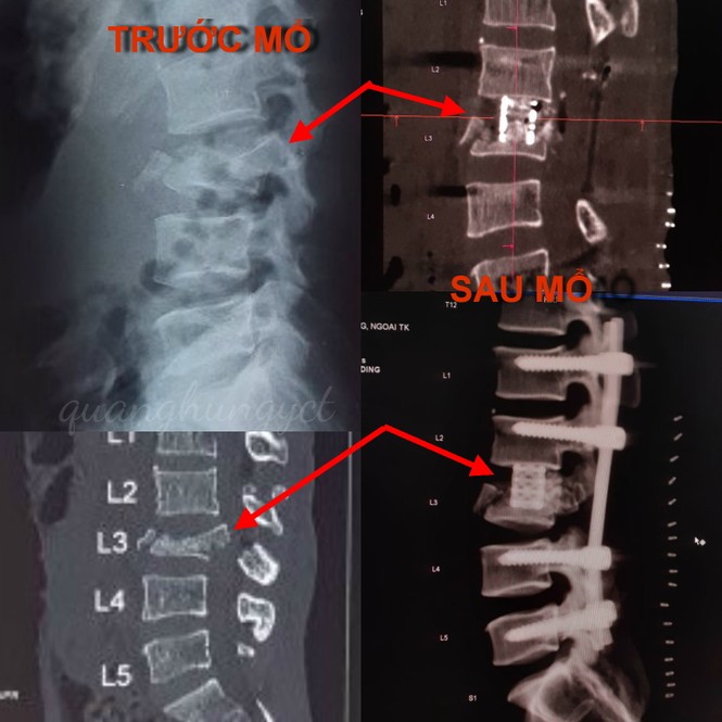 Trèo cây hái dừa, nam thanh niên ngã nát đốt sống - ảnh 1