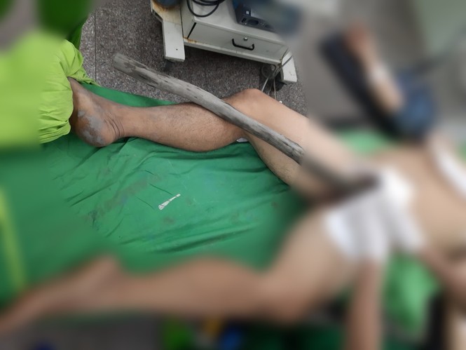 Người đàn ông mang cả cây gỗ xuyên từ tầng sinh môn đến bụng nhập viện - ảnh 1
