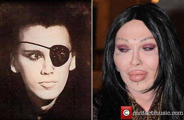Không ai còn có thể nhận ra nam ca sĩ điển trai Pete Burns của ban nhạc Dead And Alive. Anh là người đồng tính, nhưng không muốn chuyển giới, anh dùng phẩu thuật thẩm mỹ để