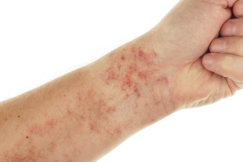 dấu hiệu lupus ban đỏ - ảnh 2