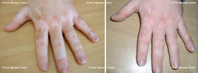 Giải pháp kết hợp điều trị hiệu quả bệnh bạch biến - ảnh 1