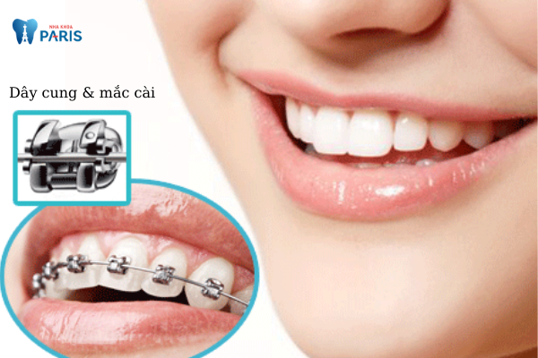Nên lựa chọn niềng răng mắc cài kim loại thường hay tự buộc? - ảnh 1