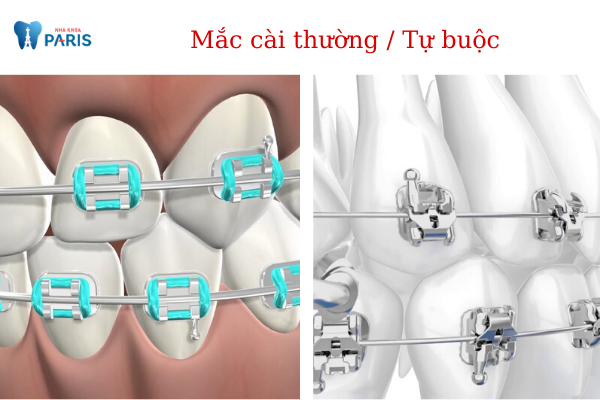 Nên lựa chọn niềng răng mắc cài kim loại thường hay tự buộc? - ảnh 2