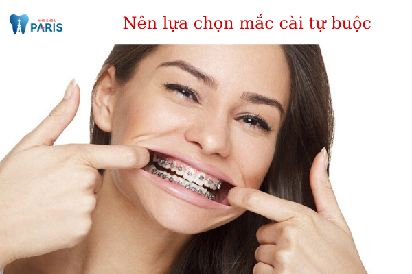 Nên lựa chọn niềng răng mắc cài kim loại thường hay tự buộc? - ảnh 3