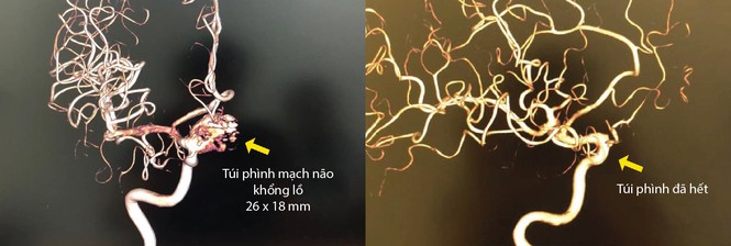 Loại bỏ hoàn toàn túi phình động mạch não lớn bằng phương pháp stent chuyển dòng - ảnh 2
