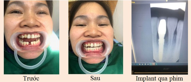 Trồng răng Implant – giải pháp toàn năng khi mất răng - ảnh 2