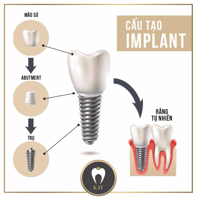 Trồng răng Implant – giải pháp toàn năng khi mất răng - ảnh 1