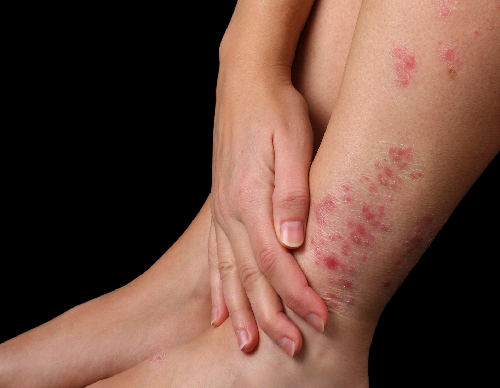 Bật mí nguyên nhân và cách điều trị bệnh vảy nến ở chân - ảnh 1