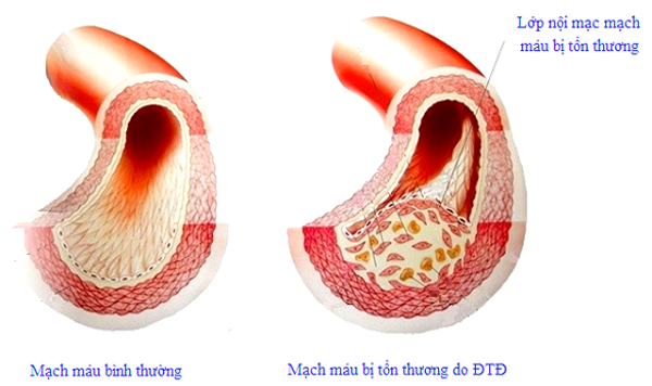 5 bí quyết vàng giúp người tiểu đường bảo vệ mình trong mùa dịch bệnh - ảnh 2