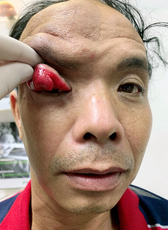 Cứu sống đôi mắt bị vùi lấp vì khối u chảy xệ đỏ tươi - ảnh 1