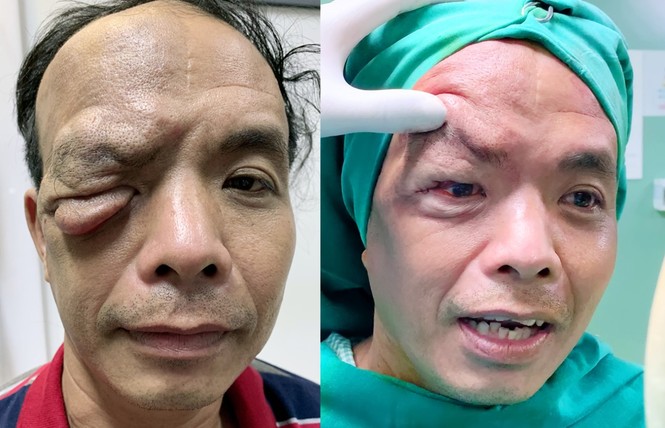Cứu sống đôi mắt bị vùi lấp vì khối u chảy xệ đỏ tươi - ảnh 5