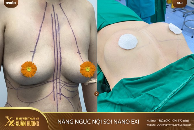 Giảm 50% nâng ngực nội soi NANO EXI tại Bệnh viện thẩm mỹ Xuân Hương - ảnh 3