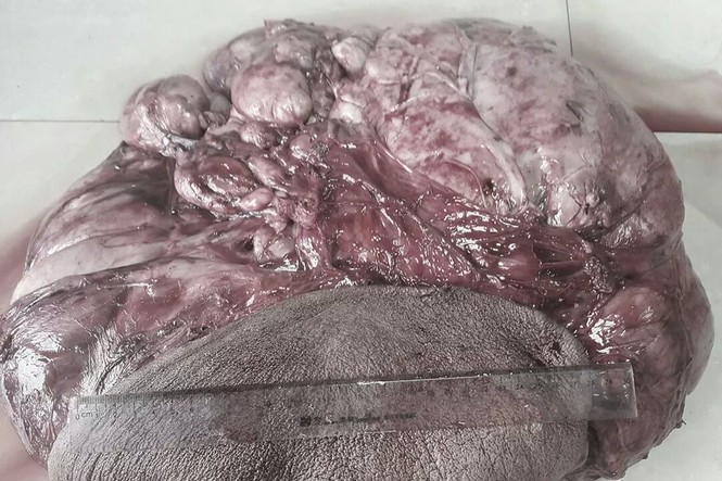 Cắt thành công khối u khổng lồ nặng 12 kg - ảnh 1