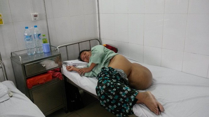 Cắt thành công khối u khổng lồ nặng 12 kg - ảnh 2