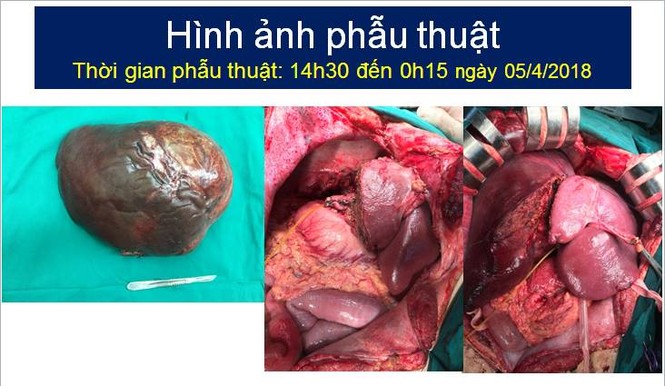 Bác sỹ đau đầu tính lượng máu cho ca cắt u gan khổng lồ - ảnh 1