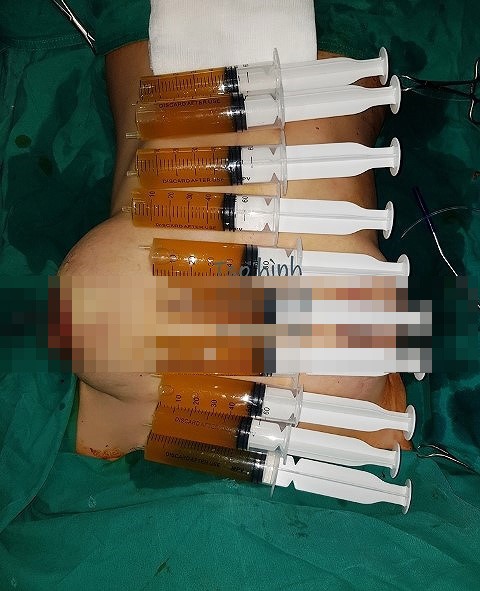 Ngực biến chứng căng như quả bóng, to nửa mét sau 'nâng cấp' - ảnh 1