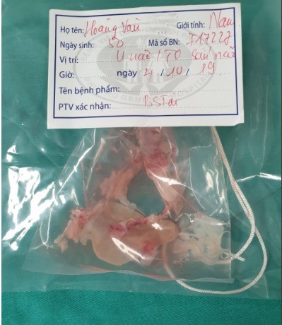 Cả ổ sán 'trú ẩn' trong não, người đàn ông yếu chân tay, mất trí nhớ - ảnh 1