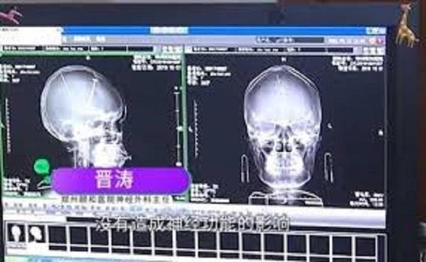 Bị đập đầu nên đi chụp não cho chắc, choáng váng phát hiện ra 2 cái kim nằm sâu trong não - ảnh 3