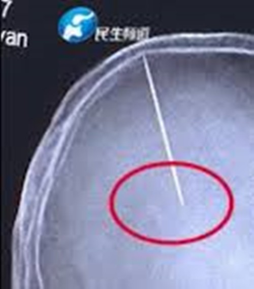 Bị đập đầu nên đi chụp não cho chắc, choáng váng phát hiện ra 2 cái kim nằm sâu trong não - ảnh 2