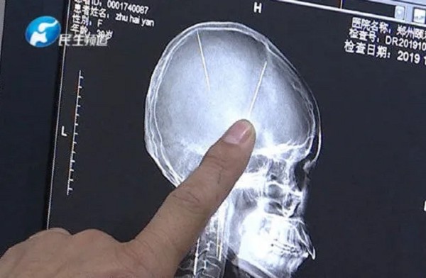 Bị đập đầu nên đi chụp não cho chắc, choáng váng phát hiện ra 2 cái kim nằm sâu trong não - ảnh 1