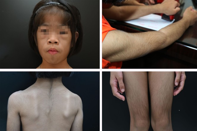 Bệnh nhân đầu tiên ở Việt Nam được phát hiện mắc di truyền hiếm gặp, thế giới chỉ vài ca - ảnh 3