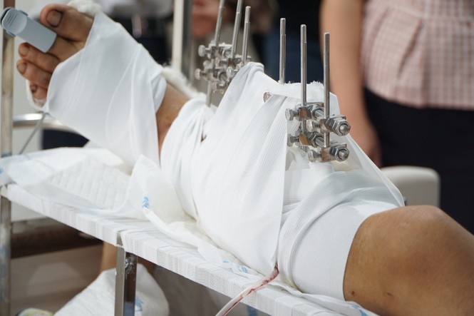 Vừa trả lời dứt câu hỏi, người đàn ông bị hai thanh niên lạ mặt chém gần đứt lìa chân - ảnh 1