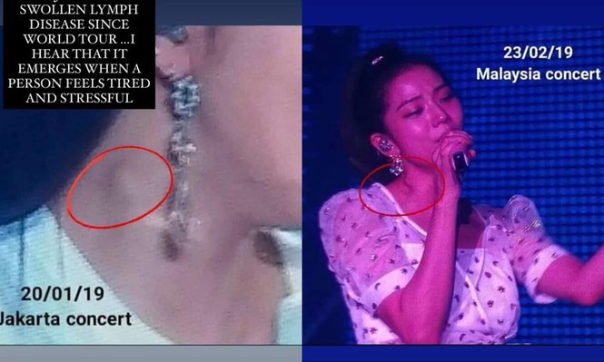 Jisoo (BLACKPINK) nổi hạch lớn ở cổ, bệnh cũ tái phát do phải làm việc đến kiệt sức? - ảnh 2