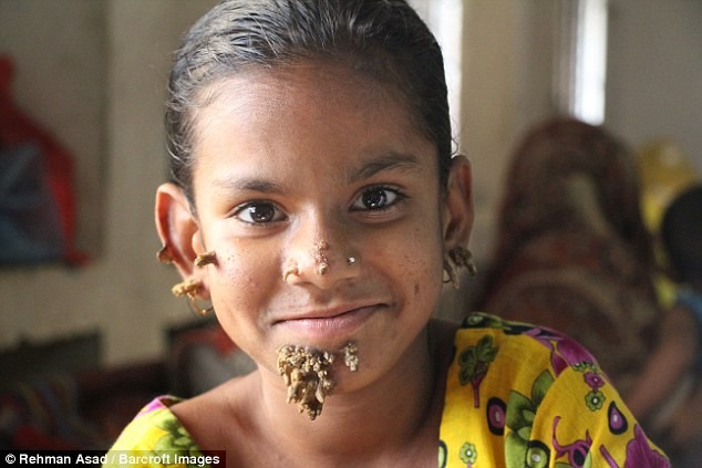 Kỳ lạ cô bé 'người cây' ở Bangladesh - ảnh 2