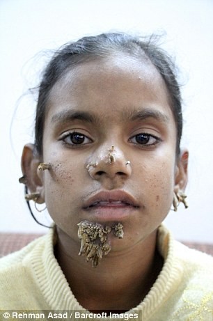Kỳ lạ cô bé 'người cây' ở Bangladesh - ảnh 3