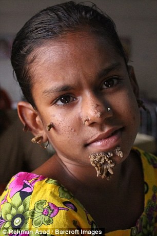 Kỳ lạ cô bé 'người cây' ở Bangladesh - ảnh 4