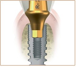 Cấy ghép răng Implant ETK Active có tác dụng thế nào? - ảnh 2