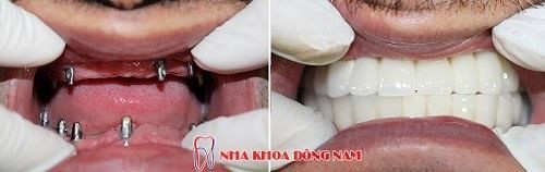 Cấy ghép răng Implant ETK Active có tác dụng thế nào? - ảnh 4