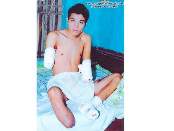 Một thanh niên bị tai nạn cụt hai tay, một chân