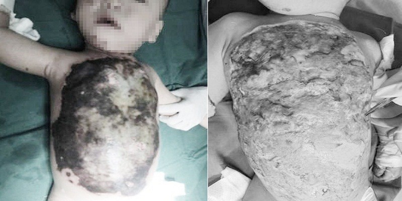 Đắp thuốc chữa bỏng của thầy lang, bé trai 13 tháng tuổi bị hoại tử da
