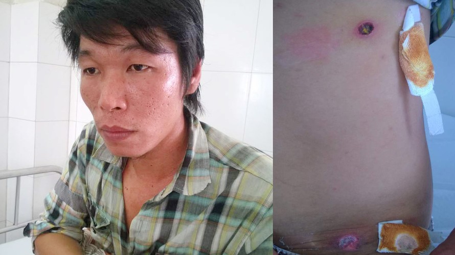 Anh Khảm trình bày sự việc và vết thương do công an thị trấn Đầm Dơi bắn. Ảnh: Dân Việt