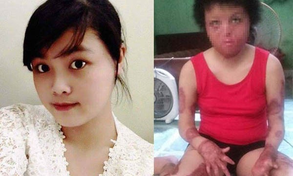 Khuôn mặt Nguyễn Thùy Dung trước và sau khi bị chồng tưới xăng đốt. Ảnh: Dân Trí