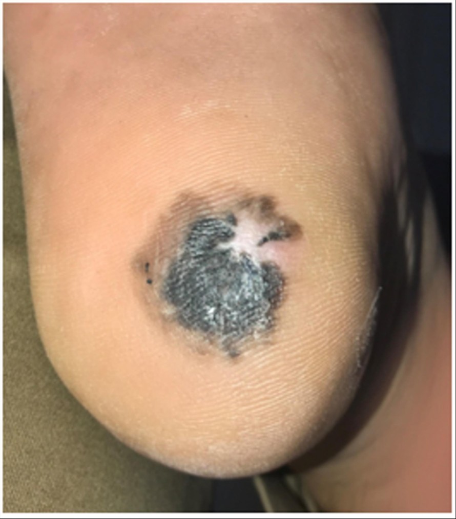 Đốm đen ở gót chân trở thành ung thư da 