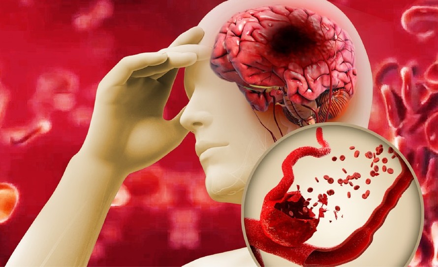 Mỡ máu cao gây biến chứng đột quỵ não