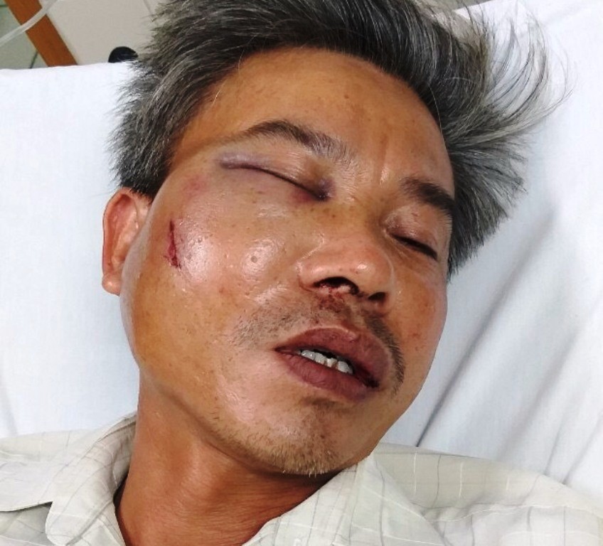 Nạn nhân Lê Song Toàn bị gãy hàm, vỡ xoang... phải can thiệp phẫu thuật để trị thương.
