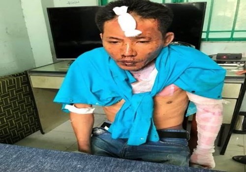 Nghi can Nguyễn Quang Dũng cũng bị bỏng nhẹ sau vụ việc