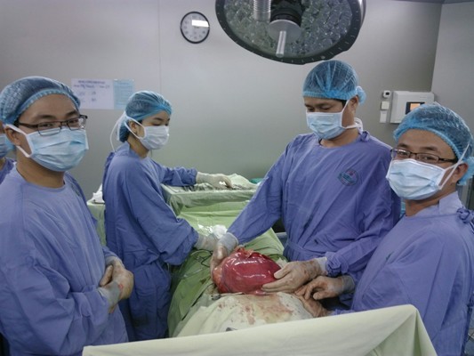 Sau gần 5 tiếng phẫu thuật, các bác sĩ đã đưa khối u khổng lồ ra khỏi bụng bệnh nhân. 
