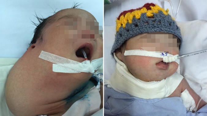 Em bé với khối u khổng lồ lúc mới chào đời. (Ảnh trái); Sức khỏe bé sơ sinh đã ổn định sau khi được lấy trọn khối u. (Ảnh phải). Ảnh do bệnh viện cung cấp.