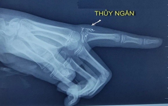 Những hạt thủy ngân trong tay qua hình ảnh phim X-quang. Ảnh: BVCC