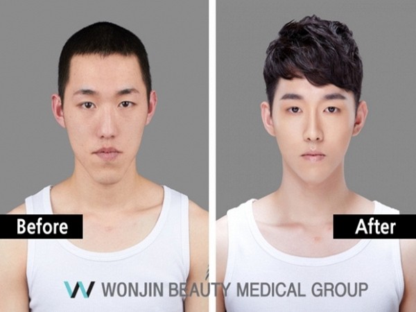 Nam giới Hàn Quốc đua nhau đi phẫu thuật thẩm mỹ để trở thành “trai xinh” như thần tượng