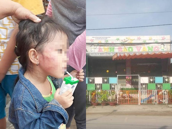 TP.HCM: Bé gái 5 tuổi bị cô giáo tát bầm tím, sưng mặt